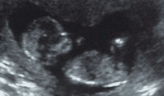De NUB-theorie: het geslacht van je baby bepalen aan de hand van een echo?